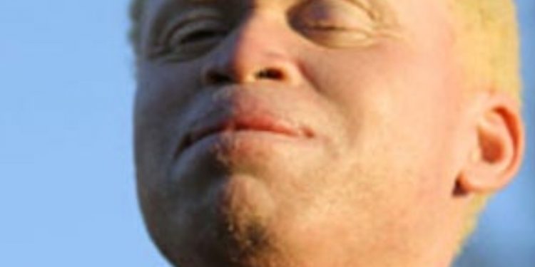 ORIGIN, PLIGHT AND BEAUTY OF ALBINOS