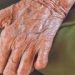 Iberekodo Leprosy Settlers striving to brain its storm